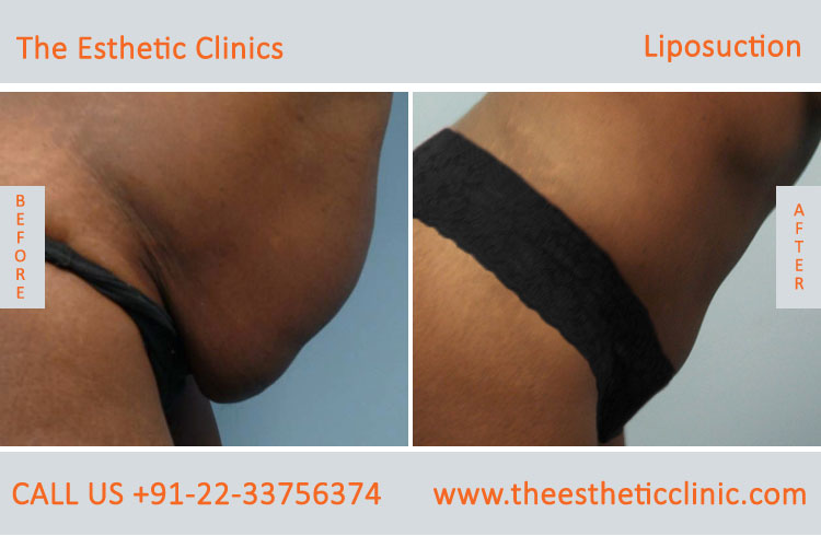 Liposuction Fat Removal Treatment before after photos in mumbai india (3)